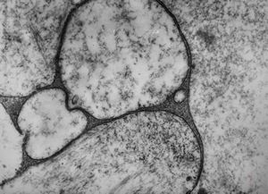 M, 1y. | gangliosidosis … bone marrow M, 1y. | gangliosidosis … bone marrow